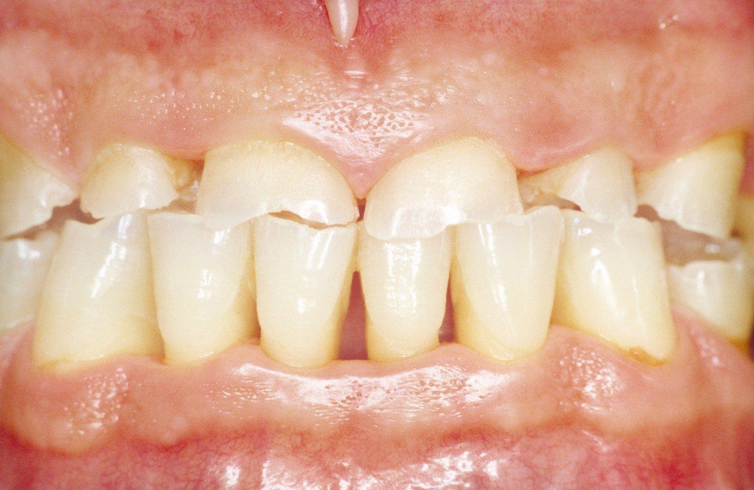 Стертые зубы