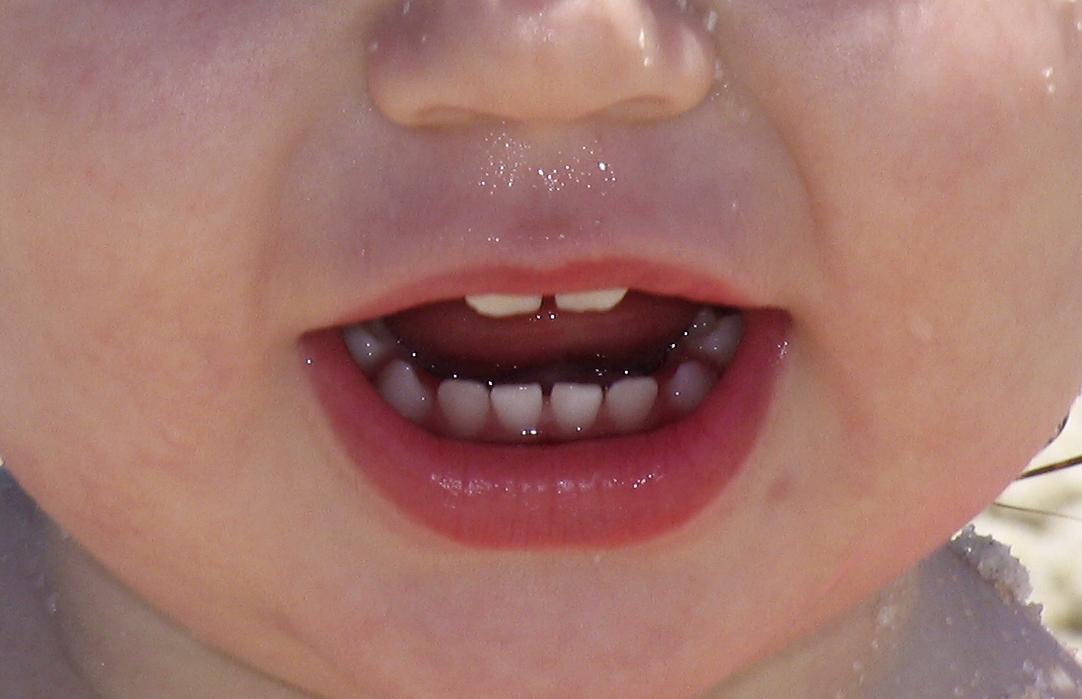 Моляры завершают процесс прорезывания зубов у грудничков
