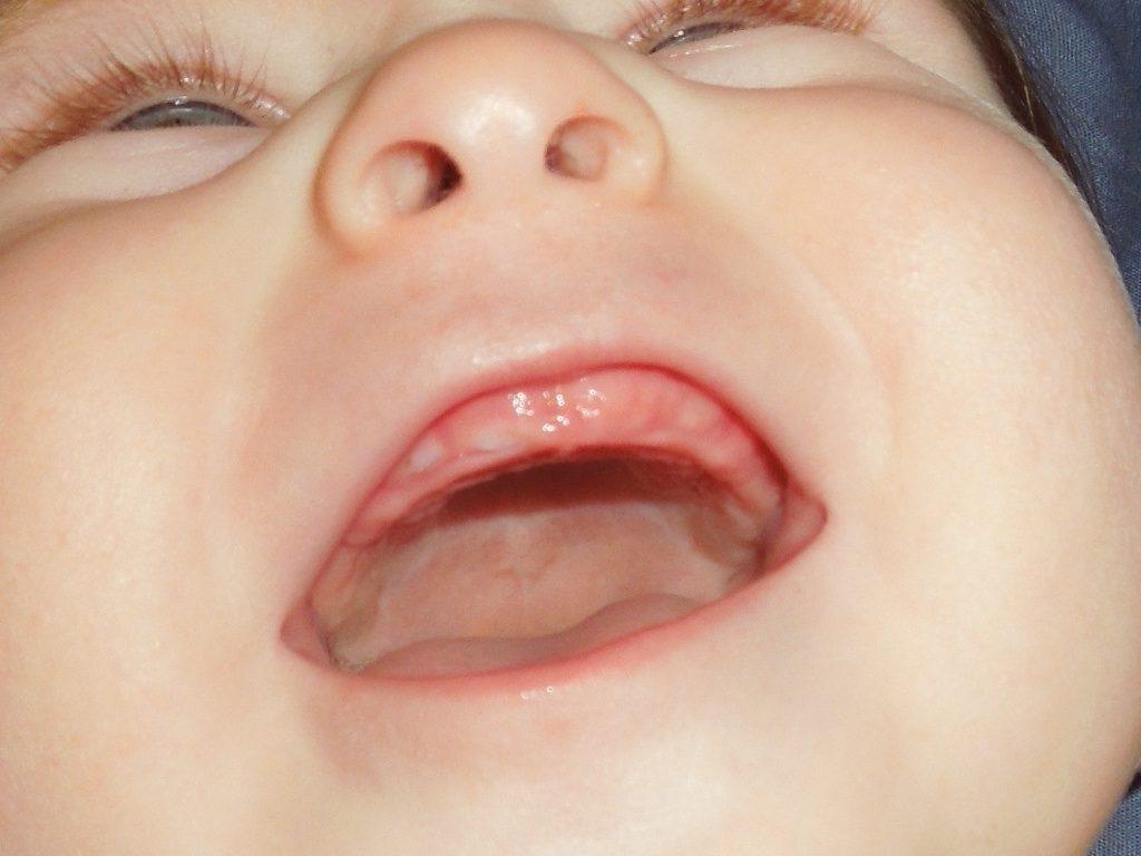 Прорезывание зубов у младенца