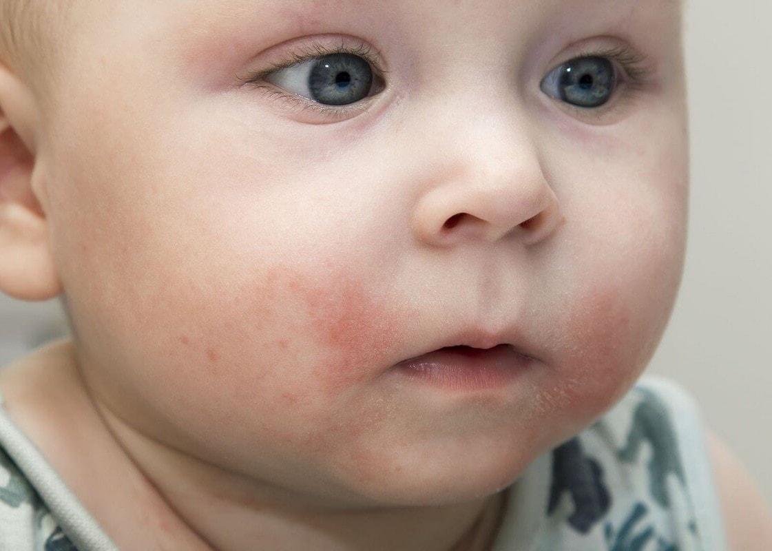 Аллергия проявляется сыпью, зудом и шелушением на коже