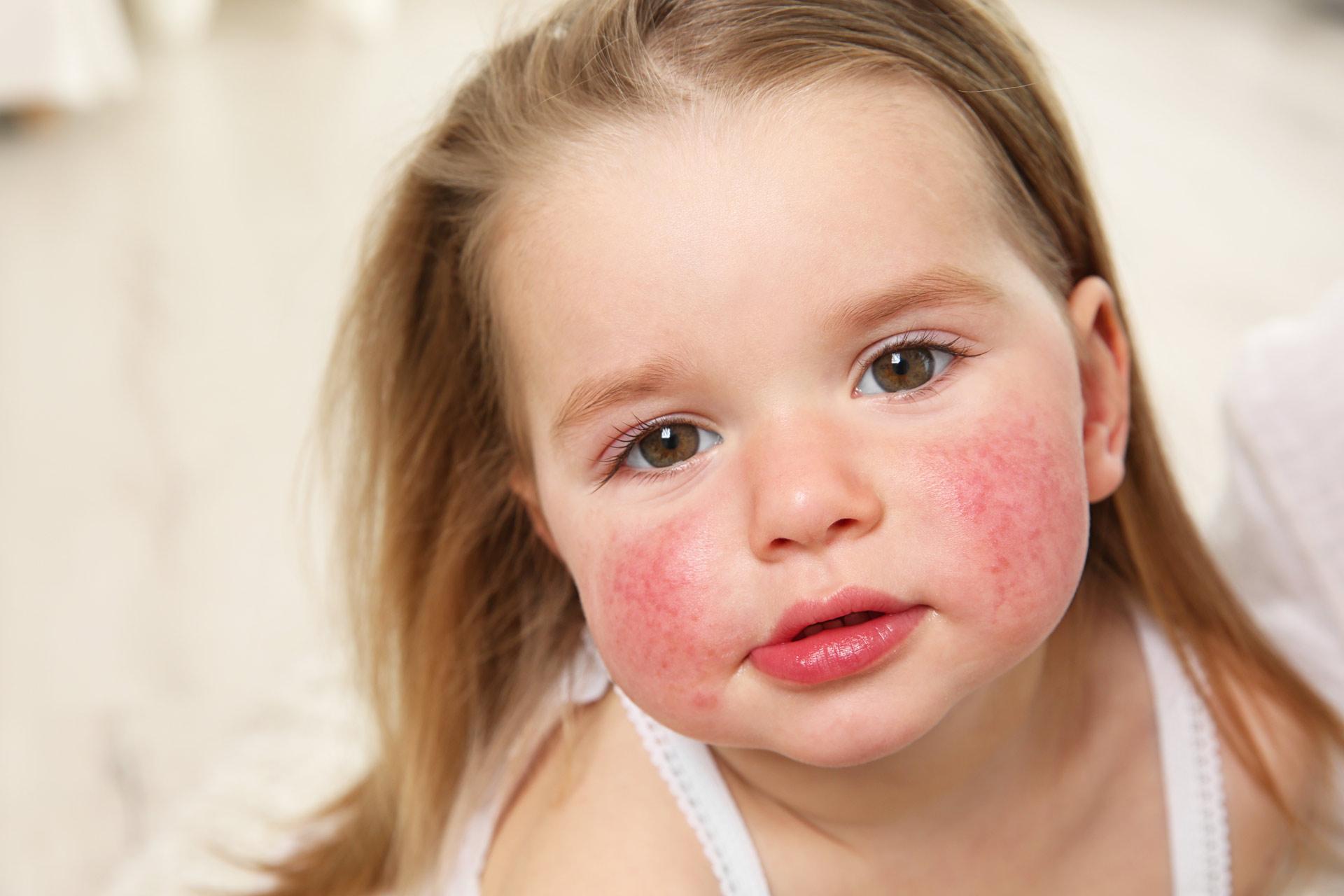 Аллергическая реакция у ребенка