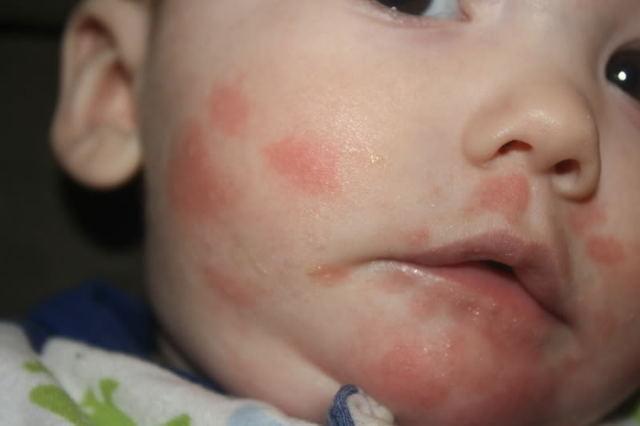 Аллергия на лактозу у младенца