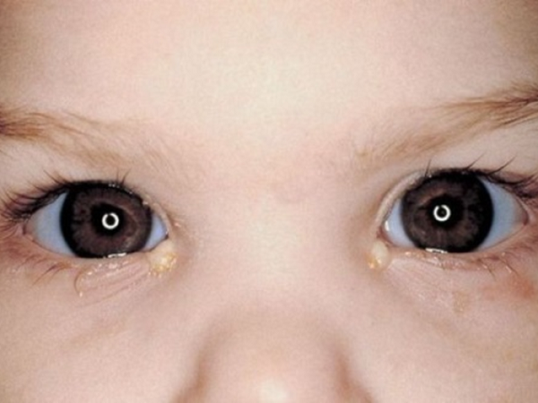 Гноение глаз новорожденного