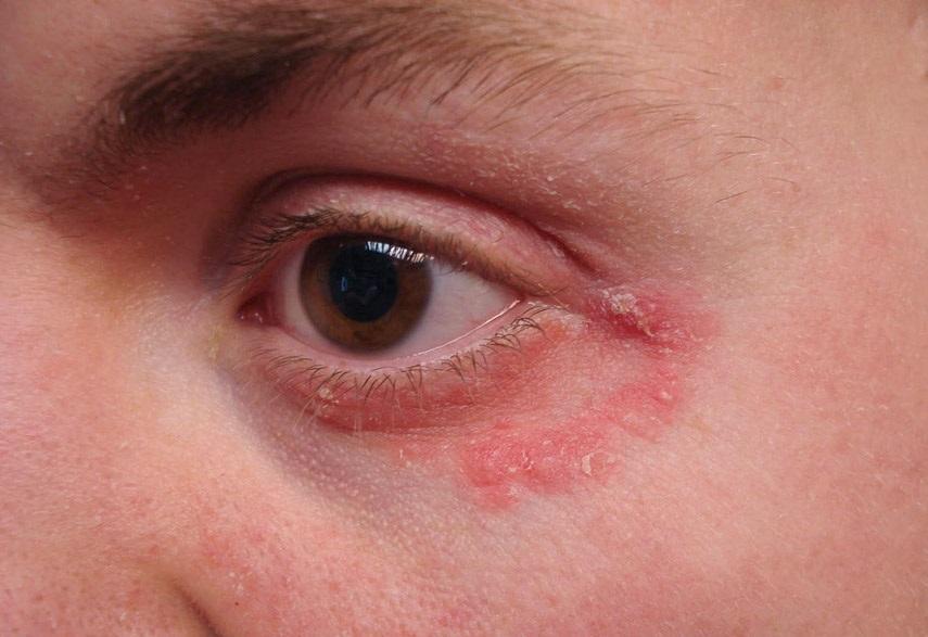 Аллергическая реакция под глазом ребенка