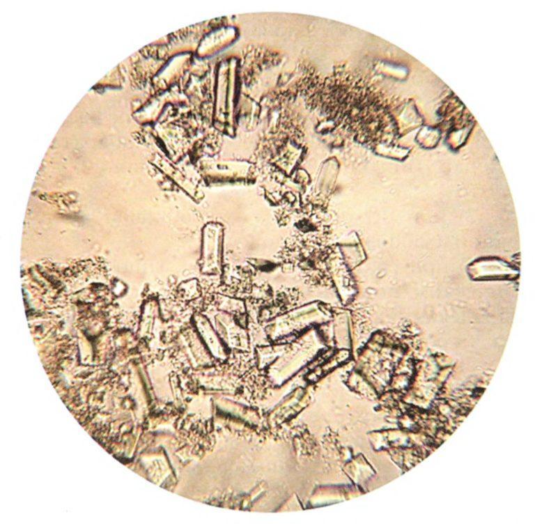 Фосфат кальция в моче под микроскопом