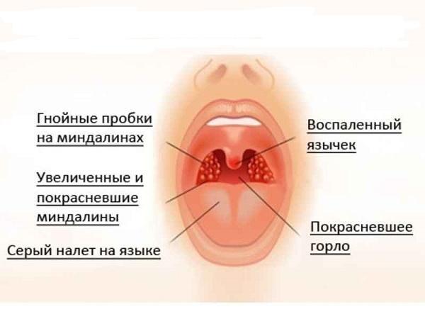 Признаки заболевания горла у грудничка