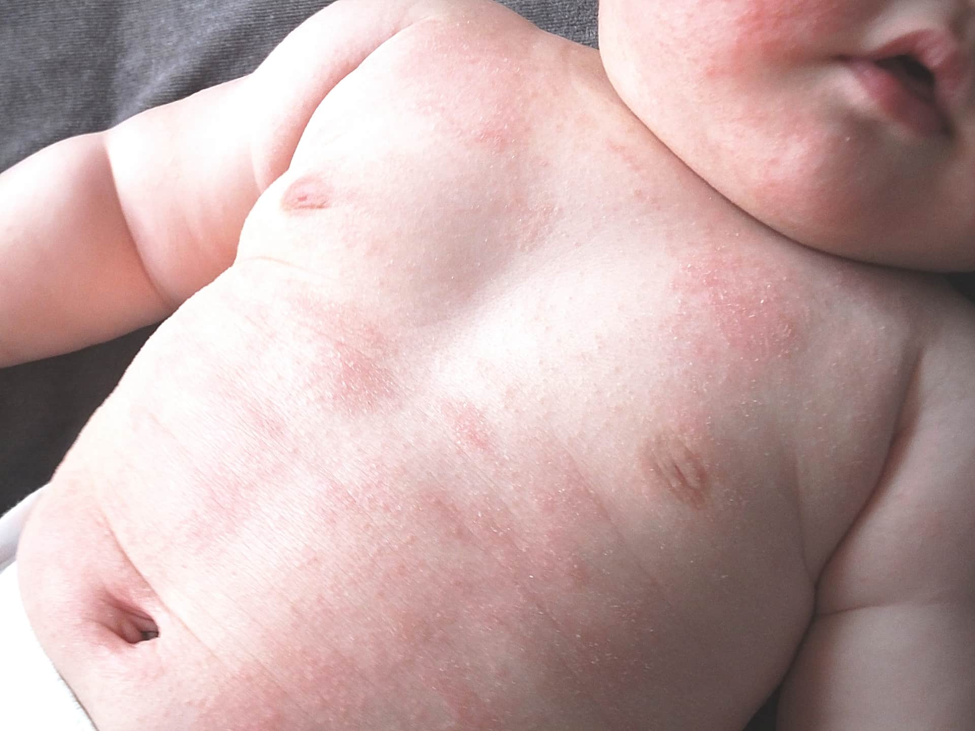 Инфекционный дерматит на коже младенца