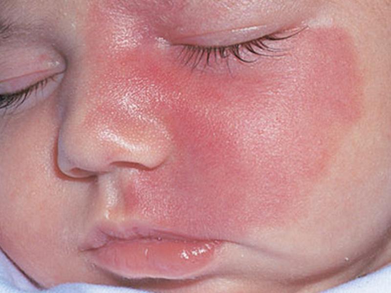 Ребенок с родовым пятном на лице
