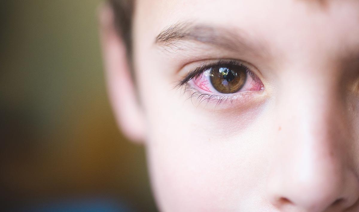 Покраснение глаз у ребенка – симптом, который может быть вызван самыми различными причинами