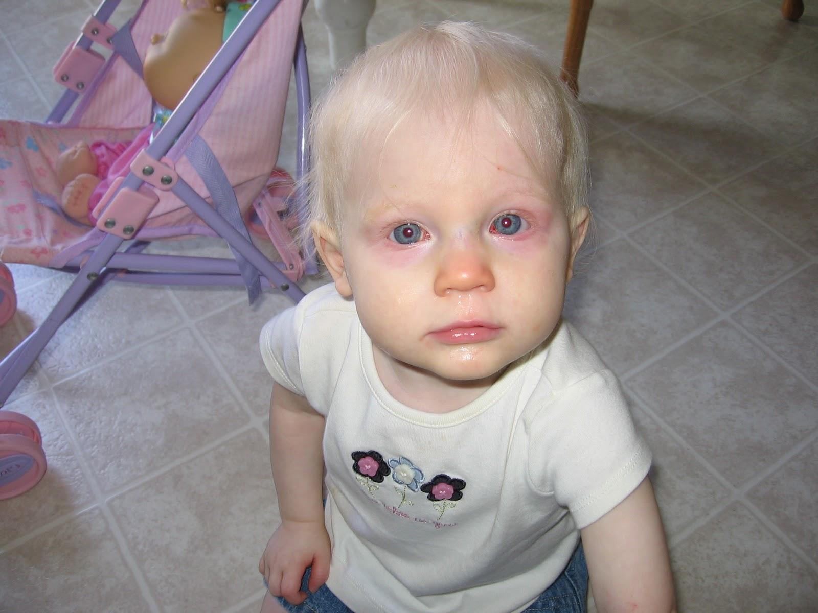 Ребенок-альбинос
