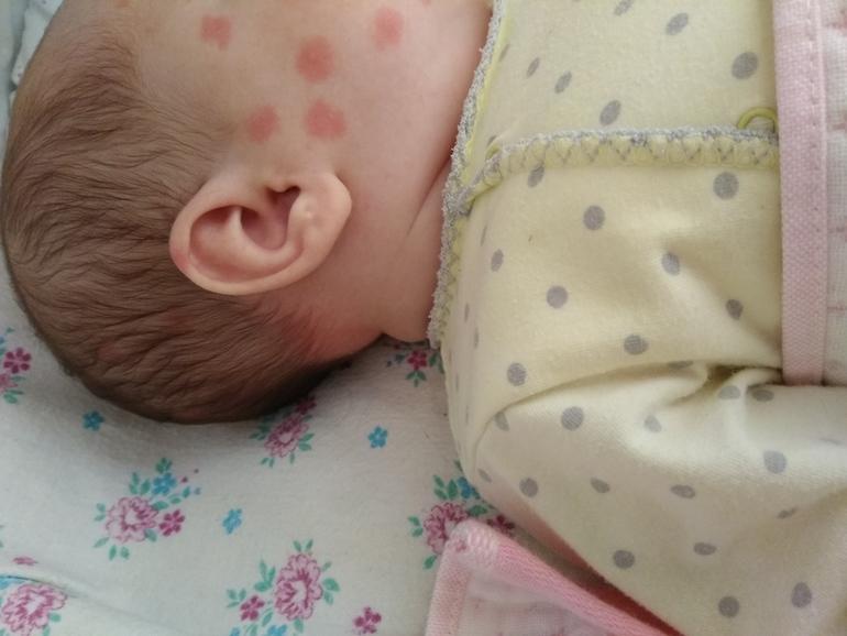 Комариные укусы у младенца