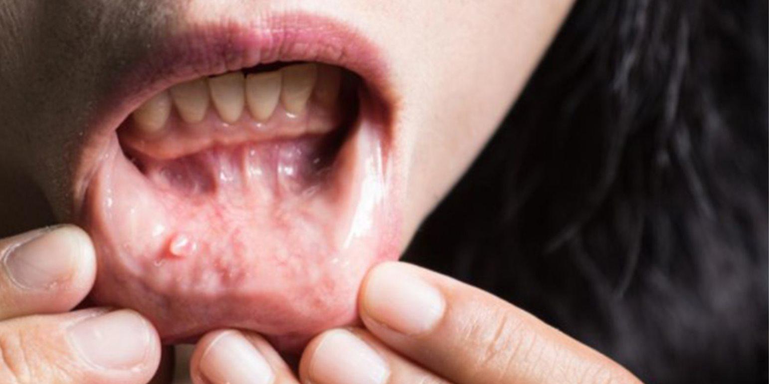 Высыпания во рту могут быть спровоцированы даже прорезыванием зубов