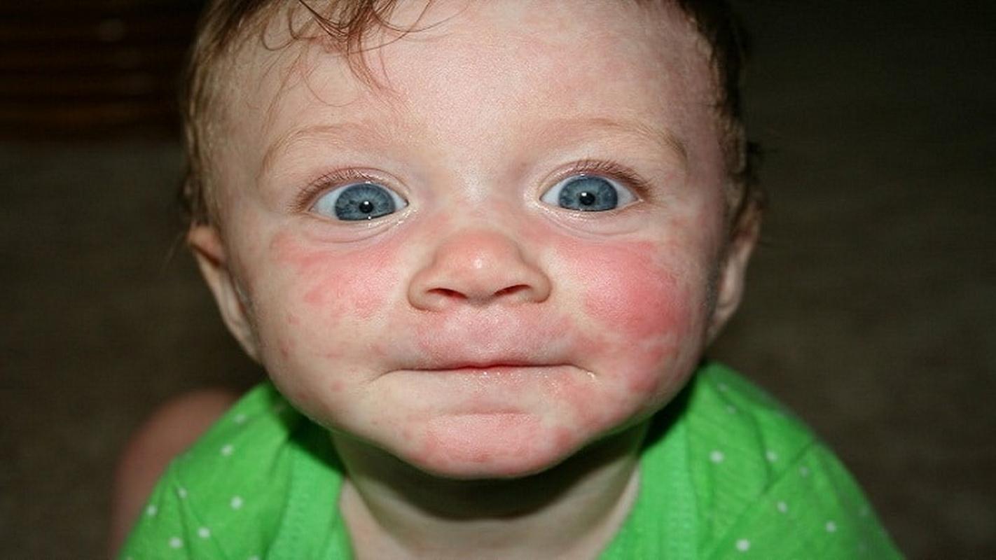 Сыпь на теле малыша появляется через 5-10 дней после поражения