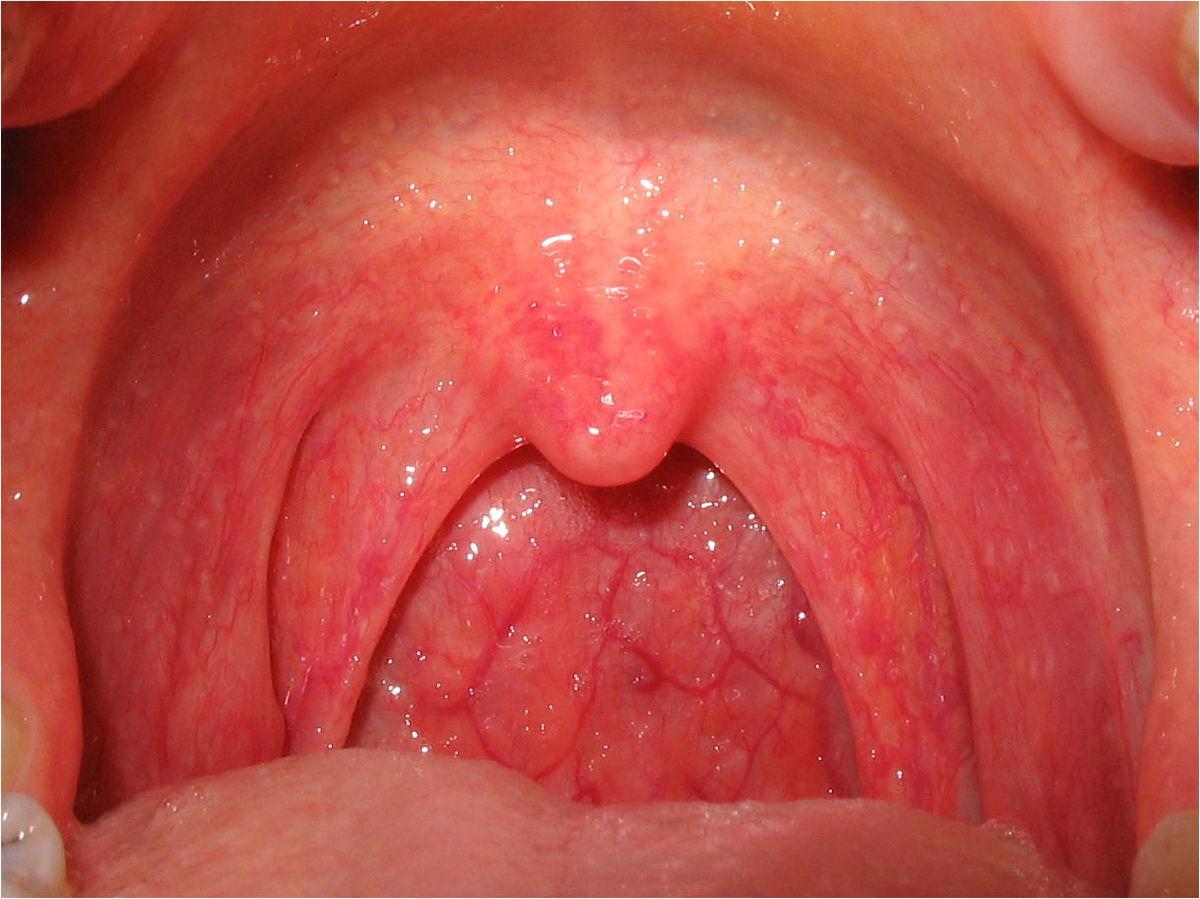 При ангине кашель сопровождается покраснением горла
