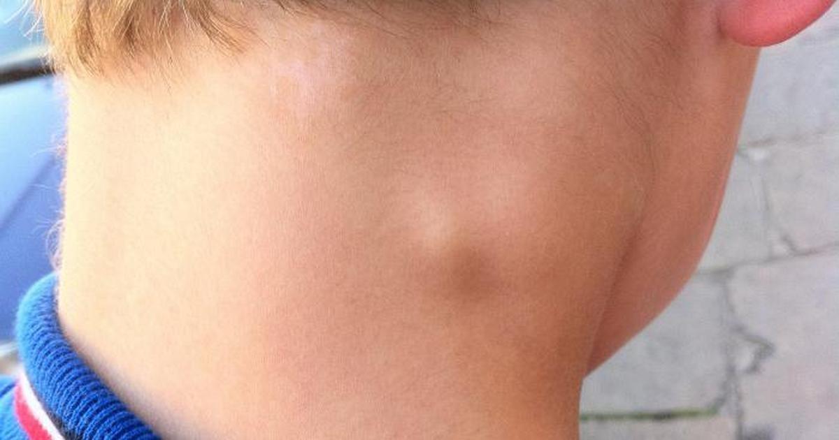Шишки на шее у ребенка – частое явление, требующее внимания родителей