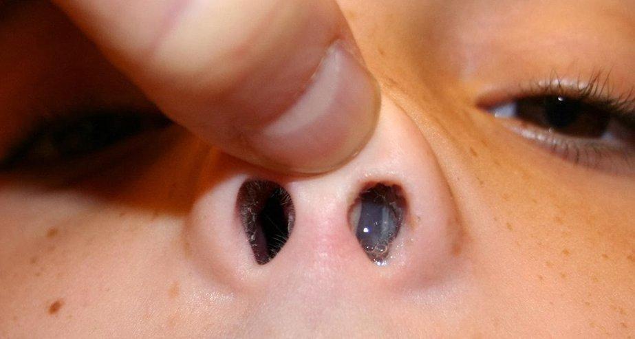 Посторонний предмет в детской ноздре