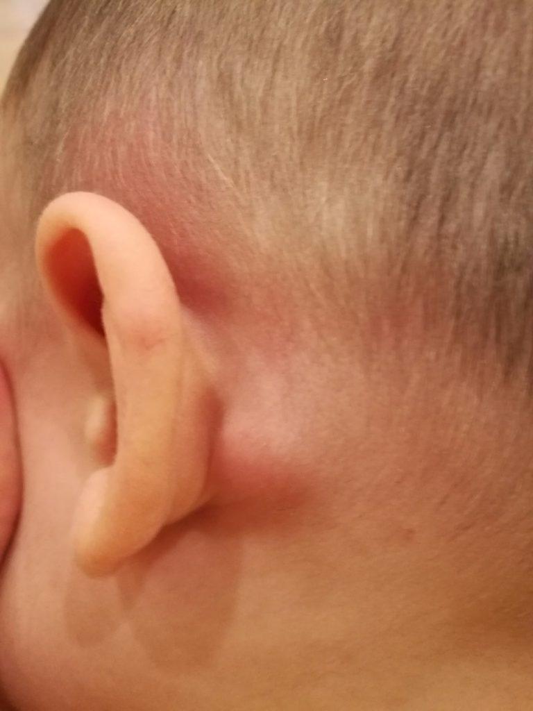 Как выглядит шишка за ухом