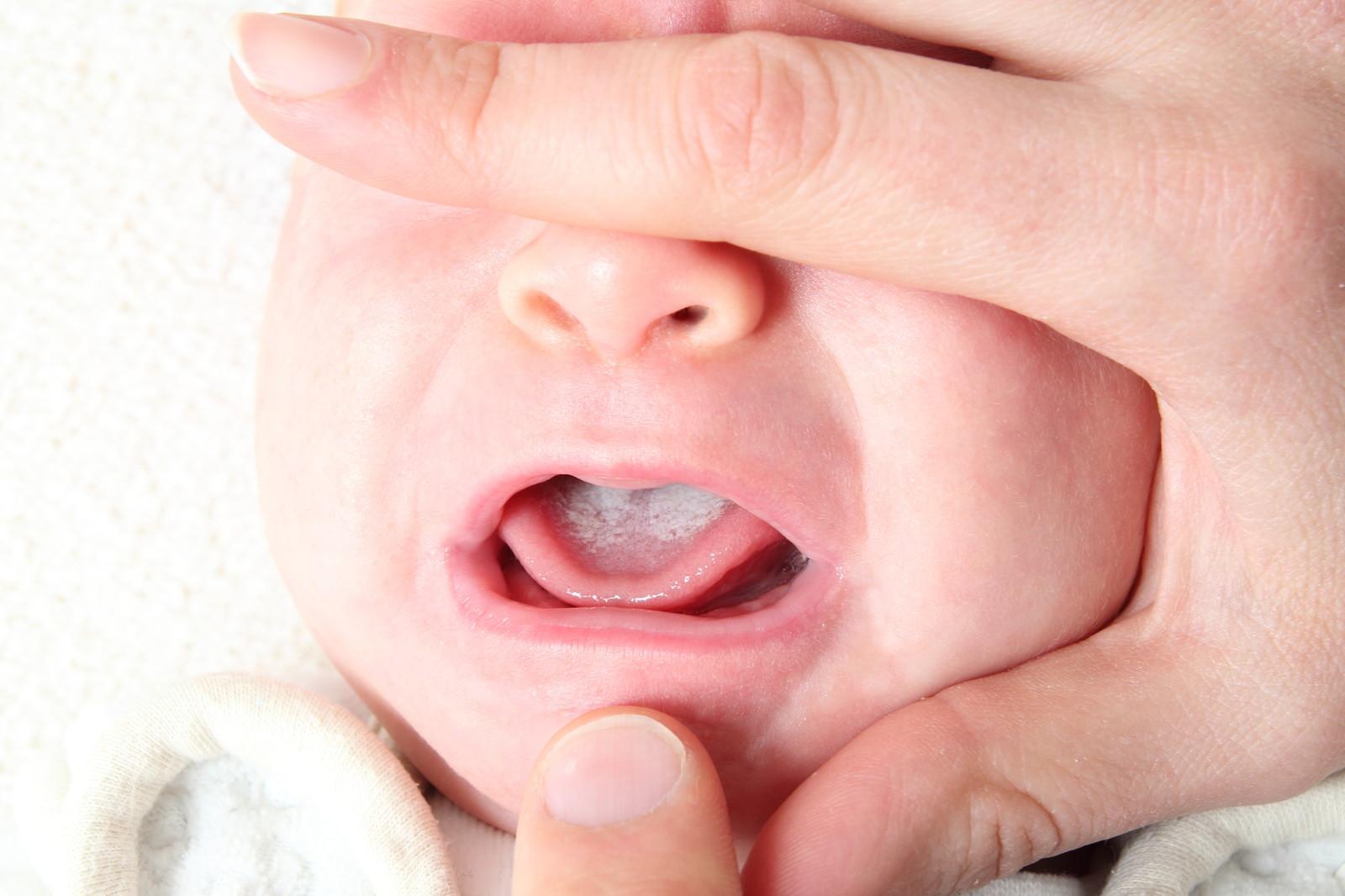 Язвочки во рту у грудничков – отнюдь не редкость