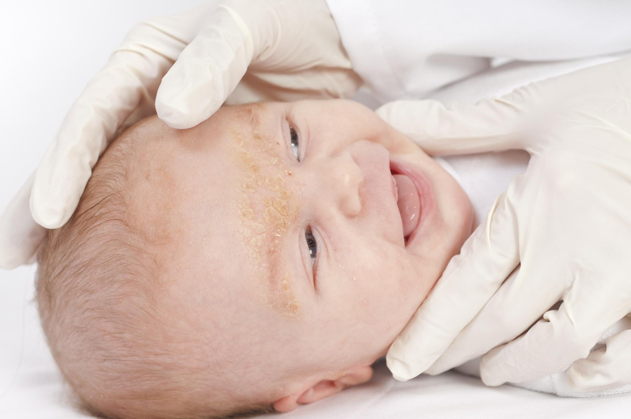От себореи страдают многие новорожденные