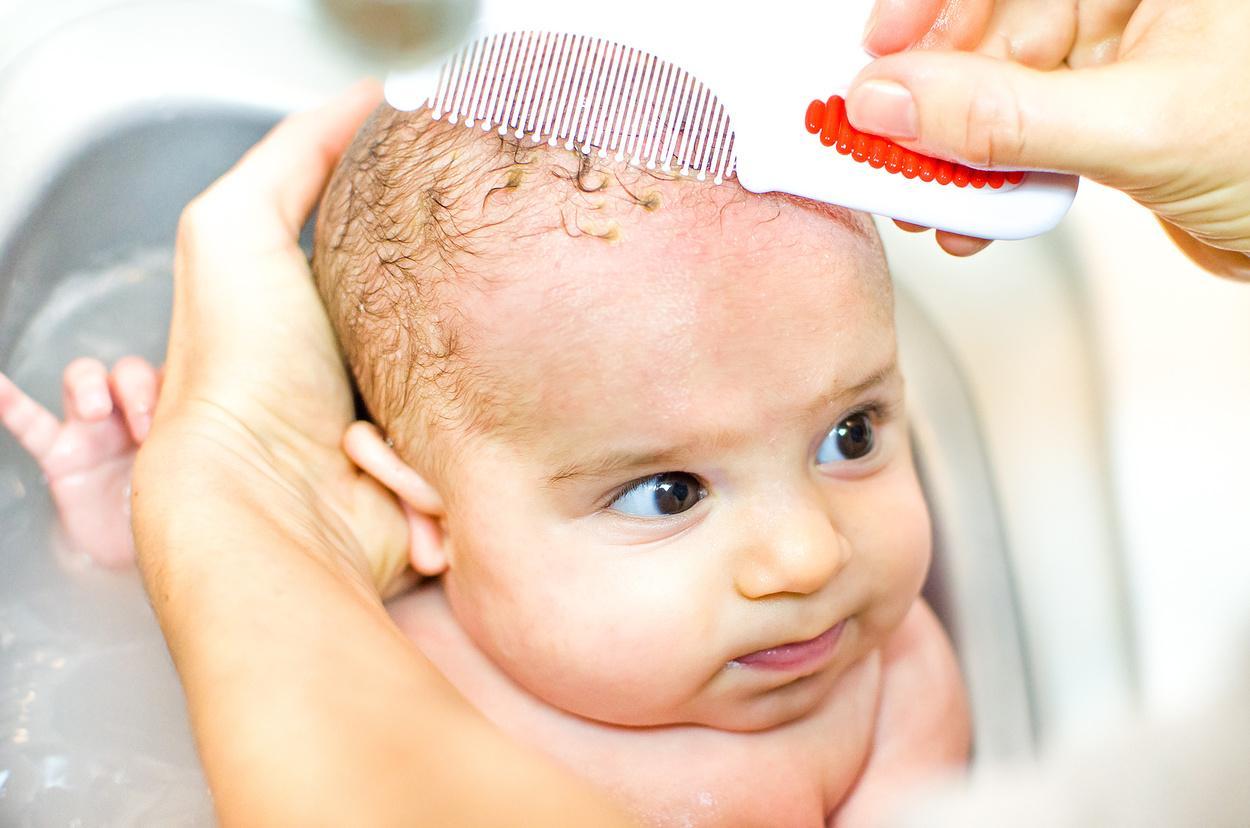 Чешуйки с головы малыша следует удалять после предварительного размягчения